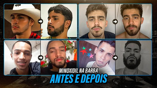 Minoxidil para Barba Funciona? Veja Resultados Antes e Depois com o Kirkland Original - BARBA LENHADOR