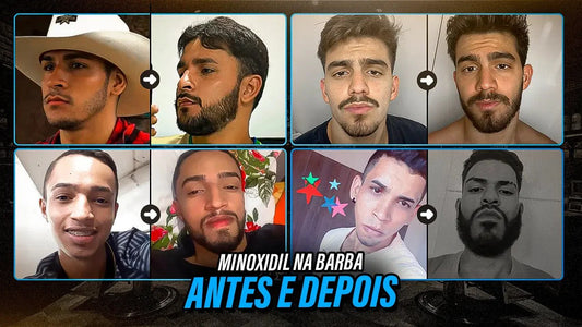 Minoxidil para Barba Funciona? Veja Resultados Antes e Depois com o Kirkland Original - BARBA LENHADOR