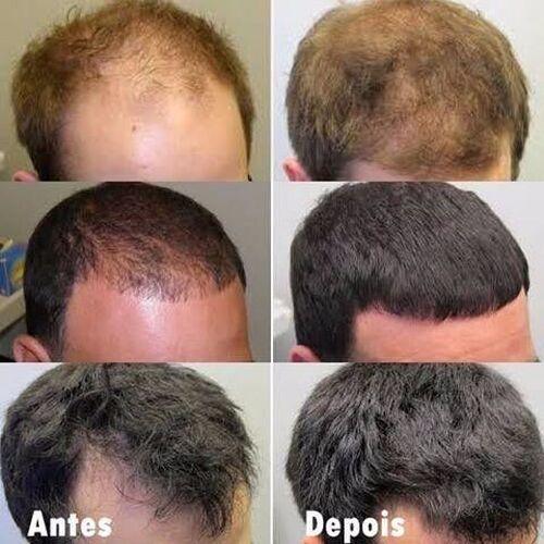Minoxidil Kirkland 5% + Vitamina Aceleradora - BARBA LENHADOR