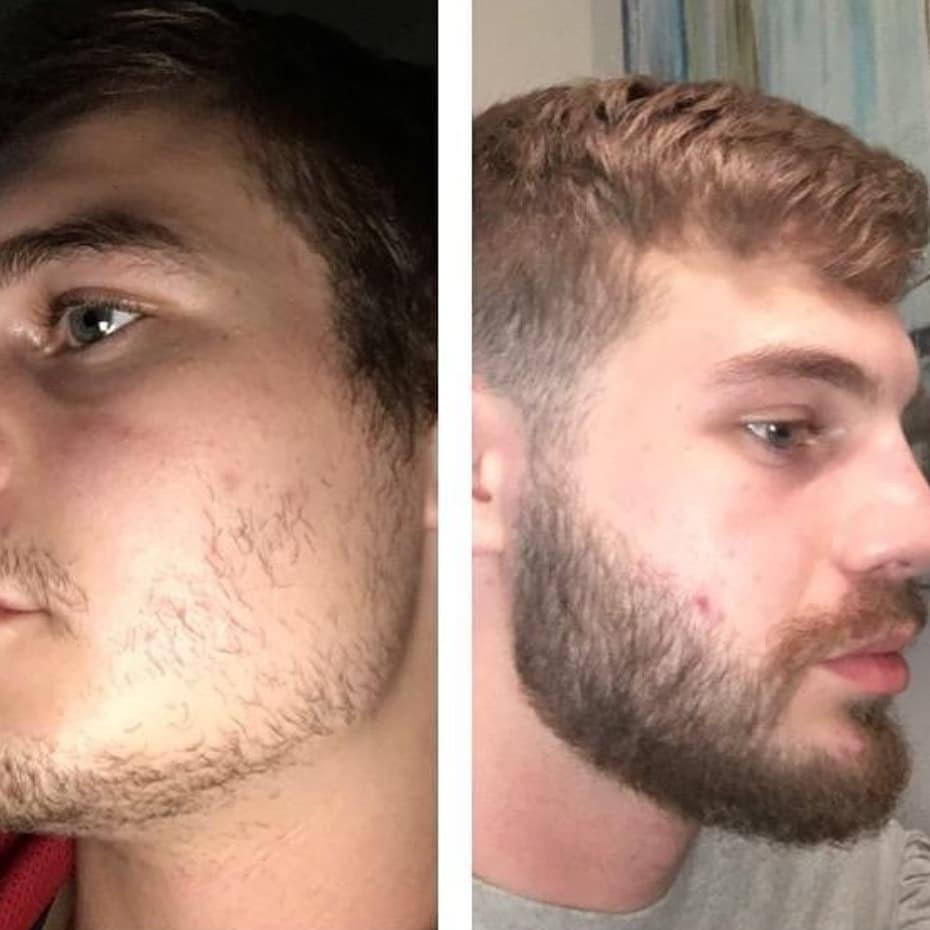 Minoxidil Kirkland 5% + Vitamina Aceleradora - BARBA LENHADOR
